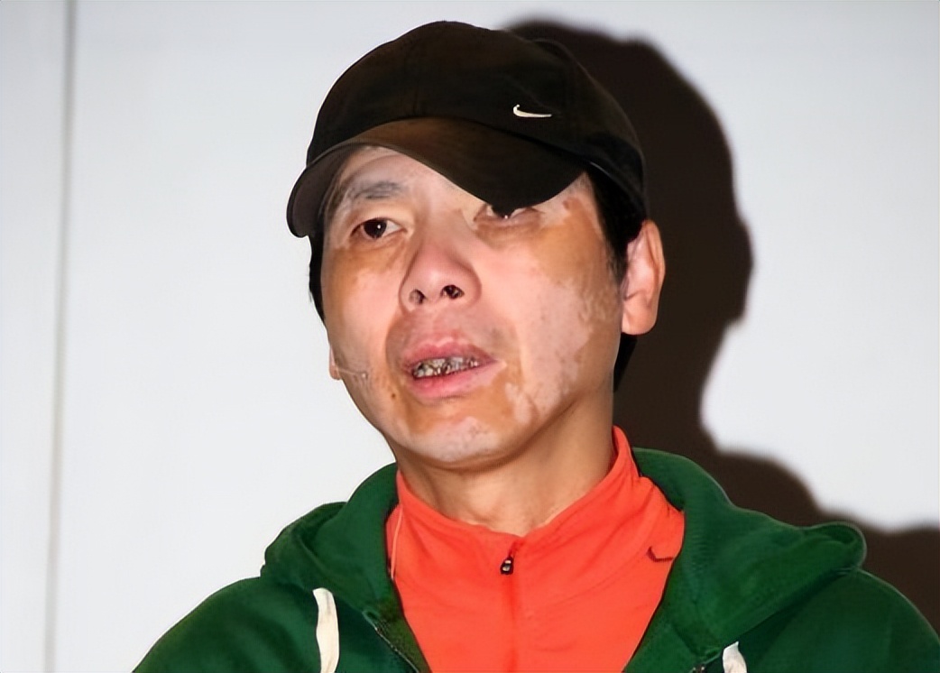 看见香蕉就流泪，一接吻嘴就肿，明星这些“隐疾”，困扰他们很久