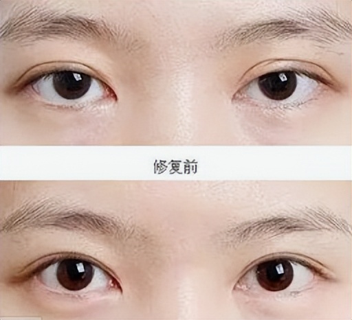 太原丽都整形医院双眼皮,太原双眼皮修复大概需要多少钱
