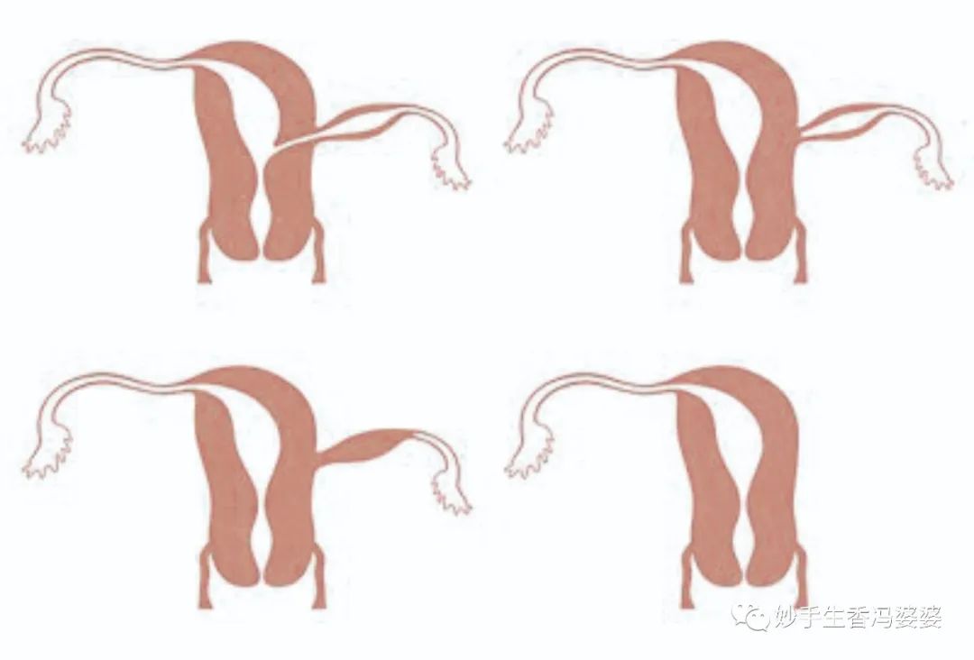 子宫畸形造成的胎停好治疗吗,子宫畸形是不是没法生孩子了