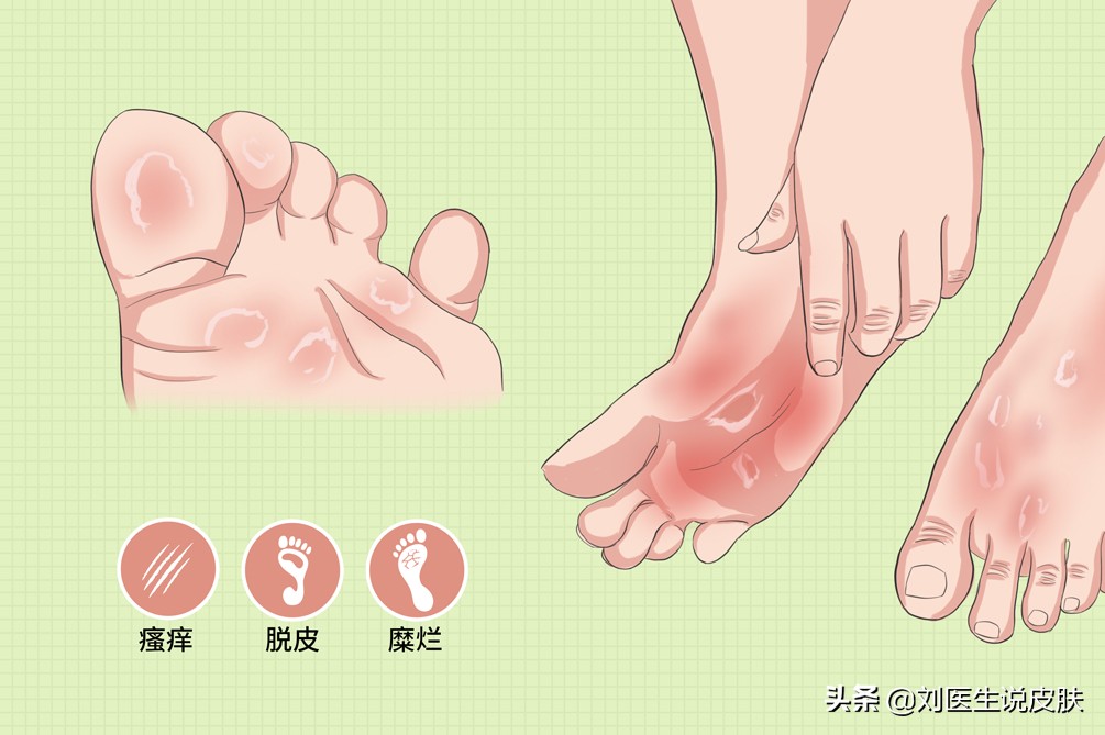 有脚气脚臭怎么去除最简单的方法,脚气脚臭怎么治教你四个简单办法
