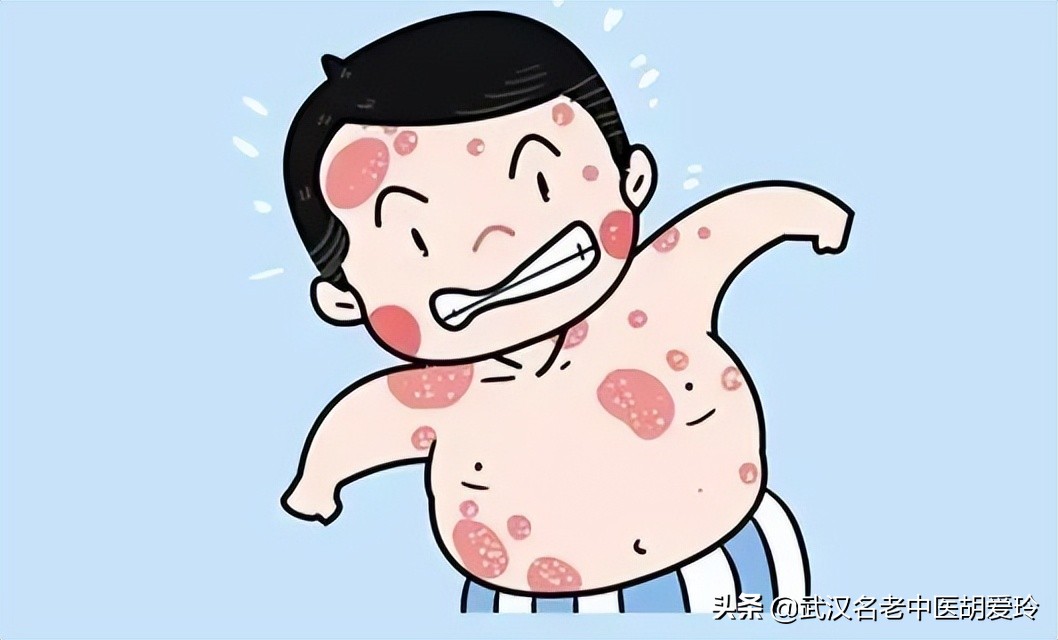 头上牛皮癣特别痒怎么办,头上有牛皮癣怎么解决