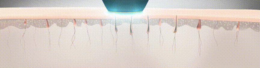 夏天脱毛要谨慎,夏天脱毛的小知识