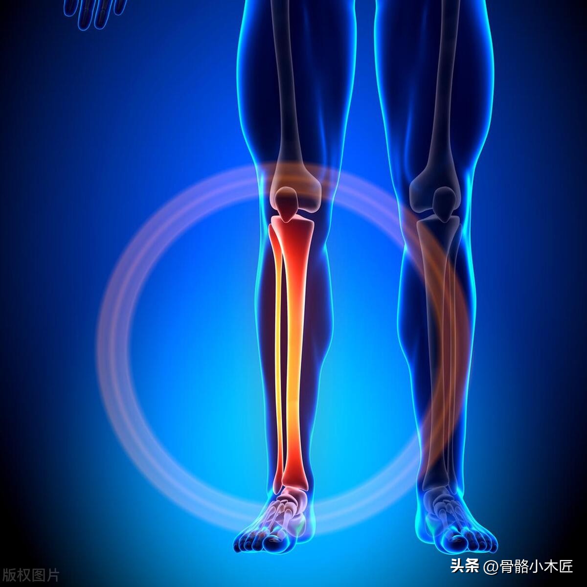 胫腓骨骨干骨折费用大概多少,胫腓骨骨干骨折是否构成伤残