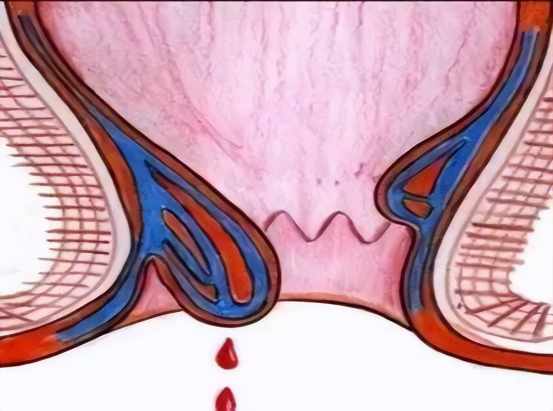 肛门瘙痒潮湿是什么原因怎么治疗,肛门周围潮湿又痒怎么治疗