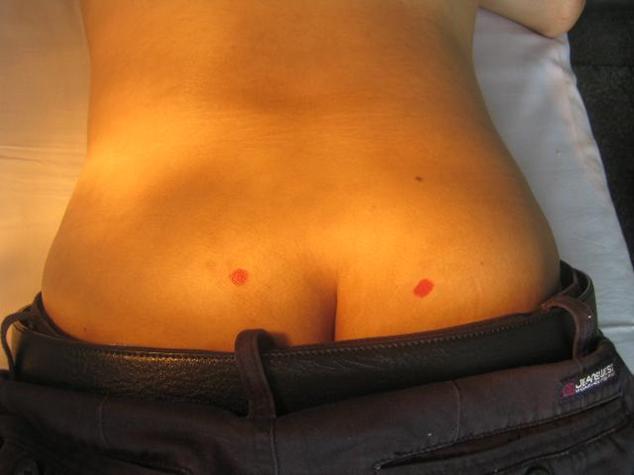 平衡针灸的深度解析图片大全,平衡针灸点穴视频