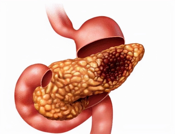 乔布斯胰腺癌的前兆,乔布斯胰腺癌有没有做手术