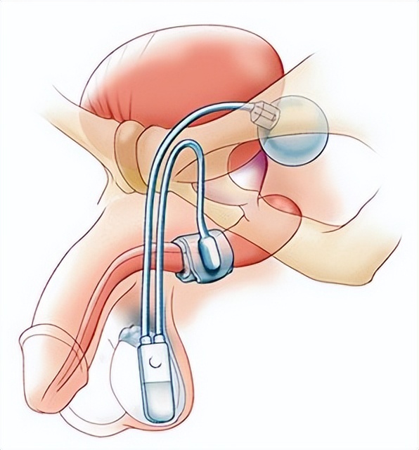 阴部神经电针刺激联合盆底肌锻炼治疗前列腺癌术后尿*禁失**