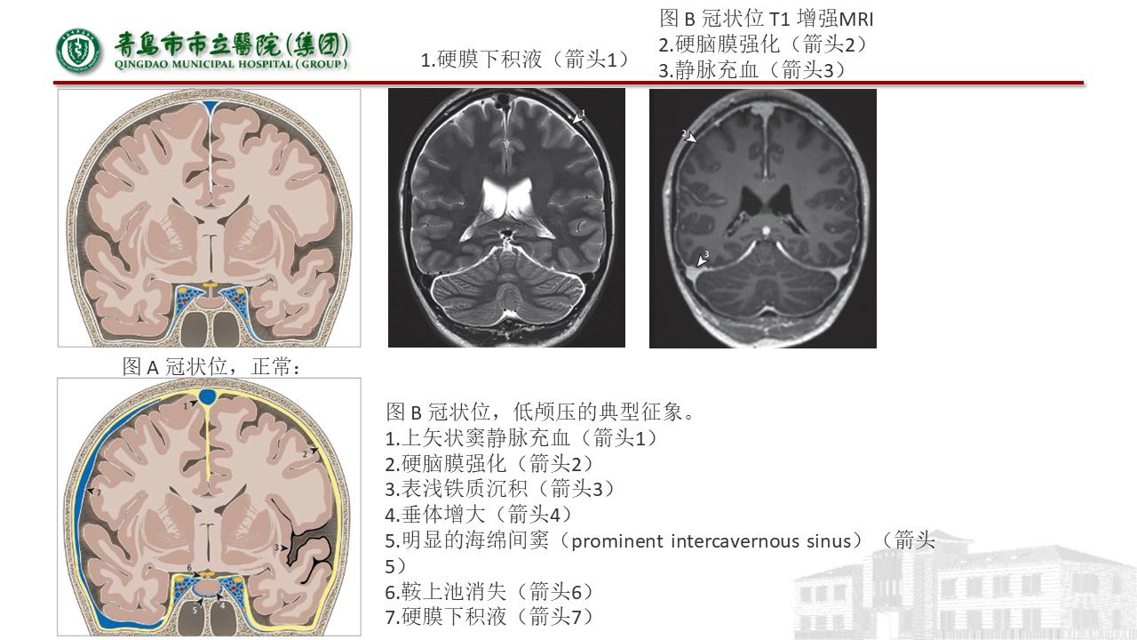 低颅压综合征耳闷,低颅压综合征吃什么药