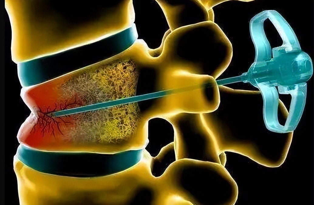 腰椎骨折的处理步骤,腰椎骨折的症状及表现