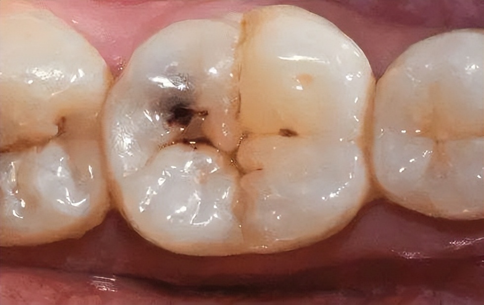 怎么快速解决牙齿酸软,牙齿酸软怎么办教你一招根除