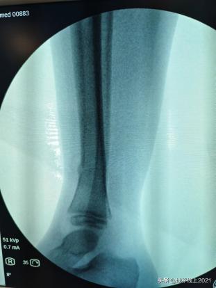 小孩被自行车撞康复要赔偿,孩子不小心被自行车撞了一下