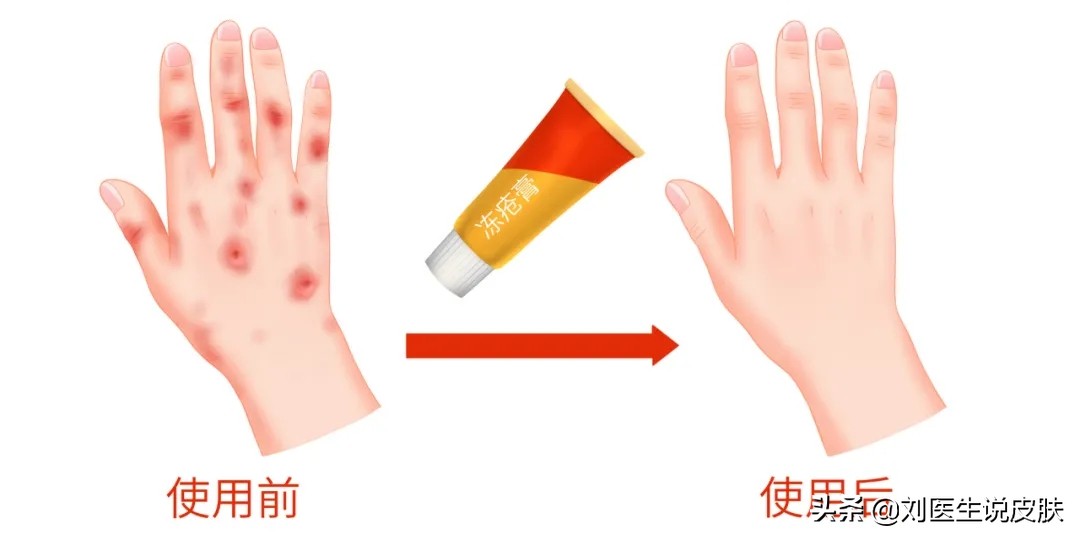 最有效冬病夏治冻疮的偏方,冻疮注意保暖