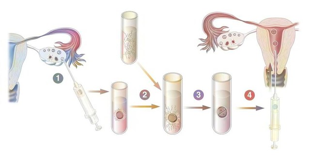 日本男子治疗白血病发现无精症,日本男子患无精症妻子接受公公捐