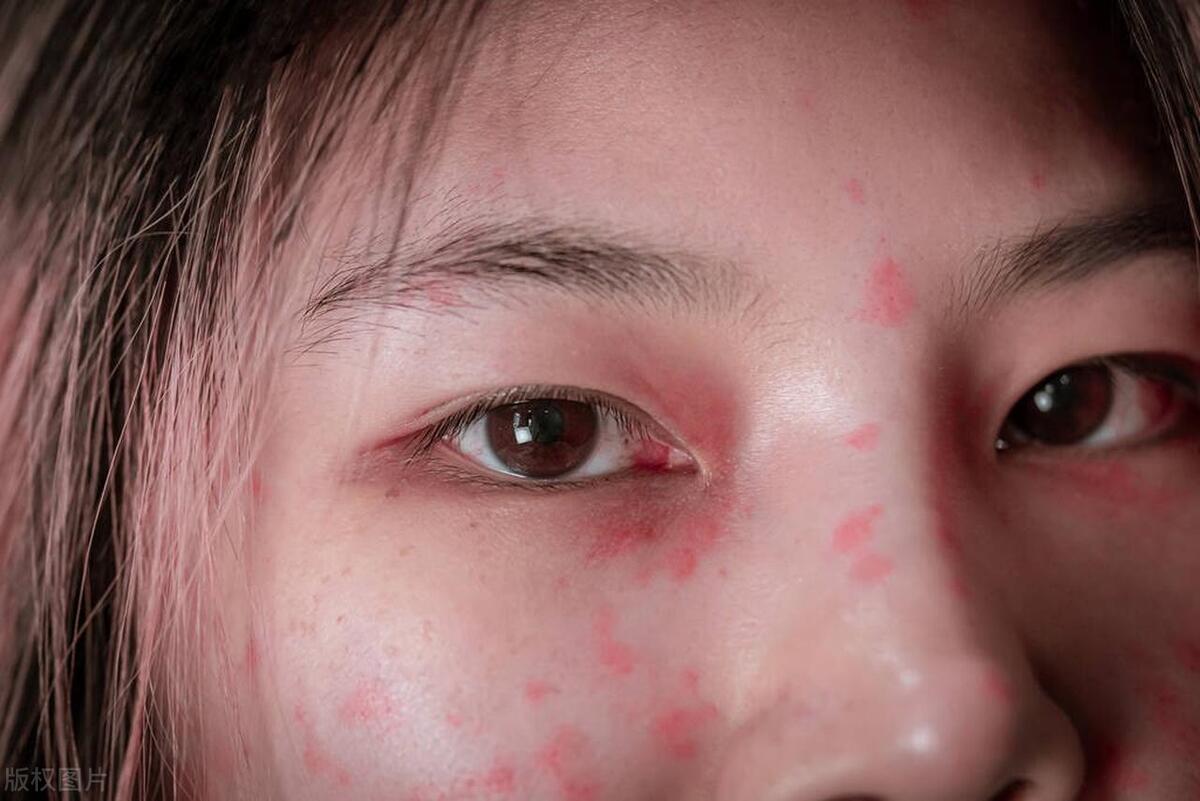 鼻子上的顽固黑头挤不出来怎么办,鼻子上的黑头一直不挤会怎么样