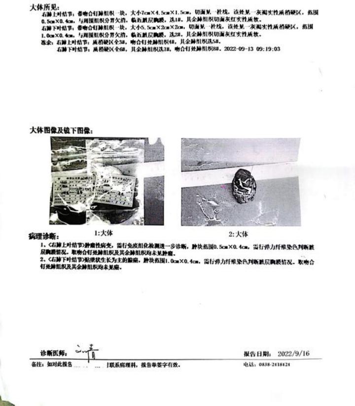 肺癌手术后什么时候能彻底恢复,肺癌手术后什么方法减轻病人痛苦