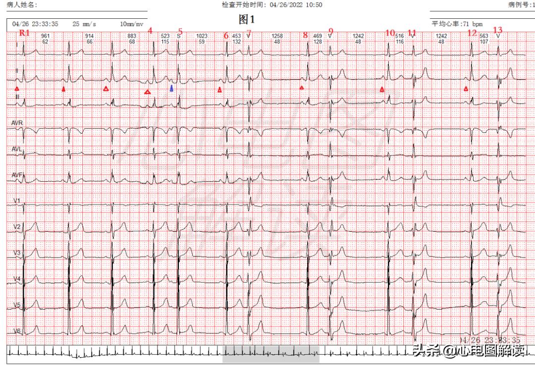 可见室性融合波是什么意思,室性融合波什么意思