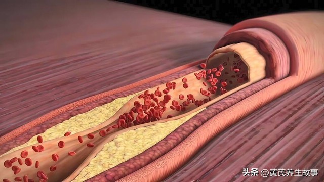 发现脑部血管堵塞怎么办,感觉大脑血管堵塞及解决方法