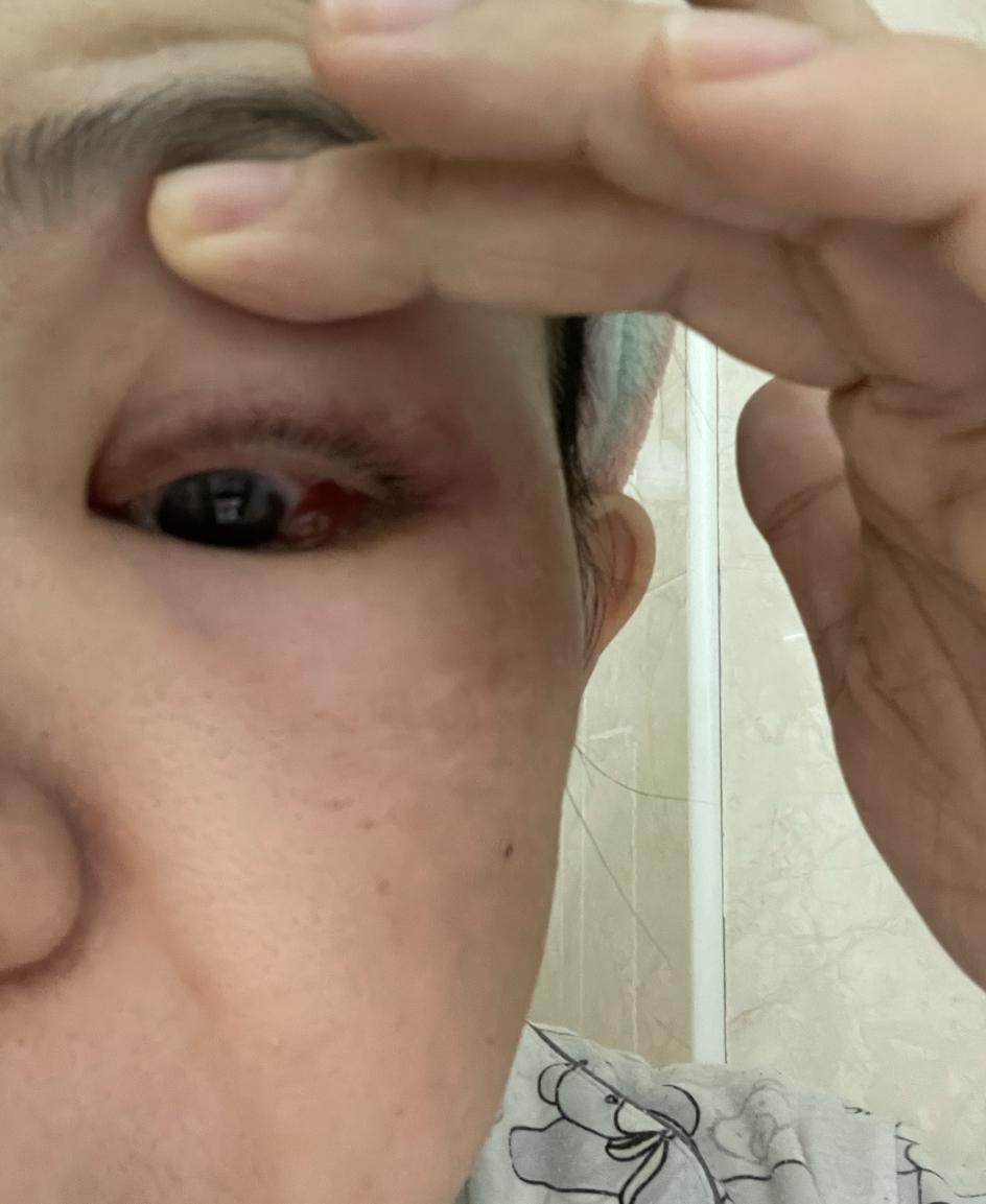 眼眶蜂窝织炎看病经验分享,患了急性眼眶蜂窝织炎如何治疗