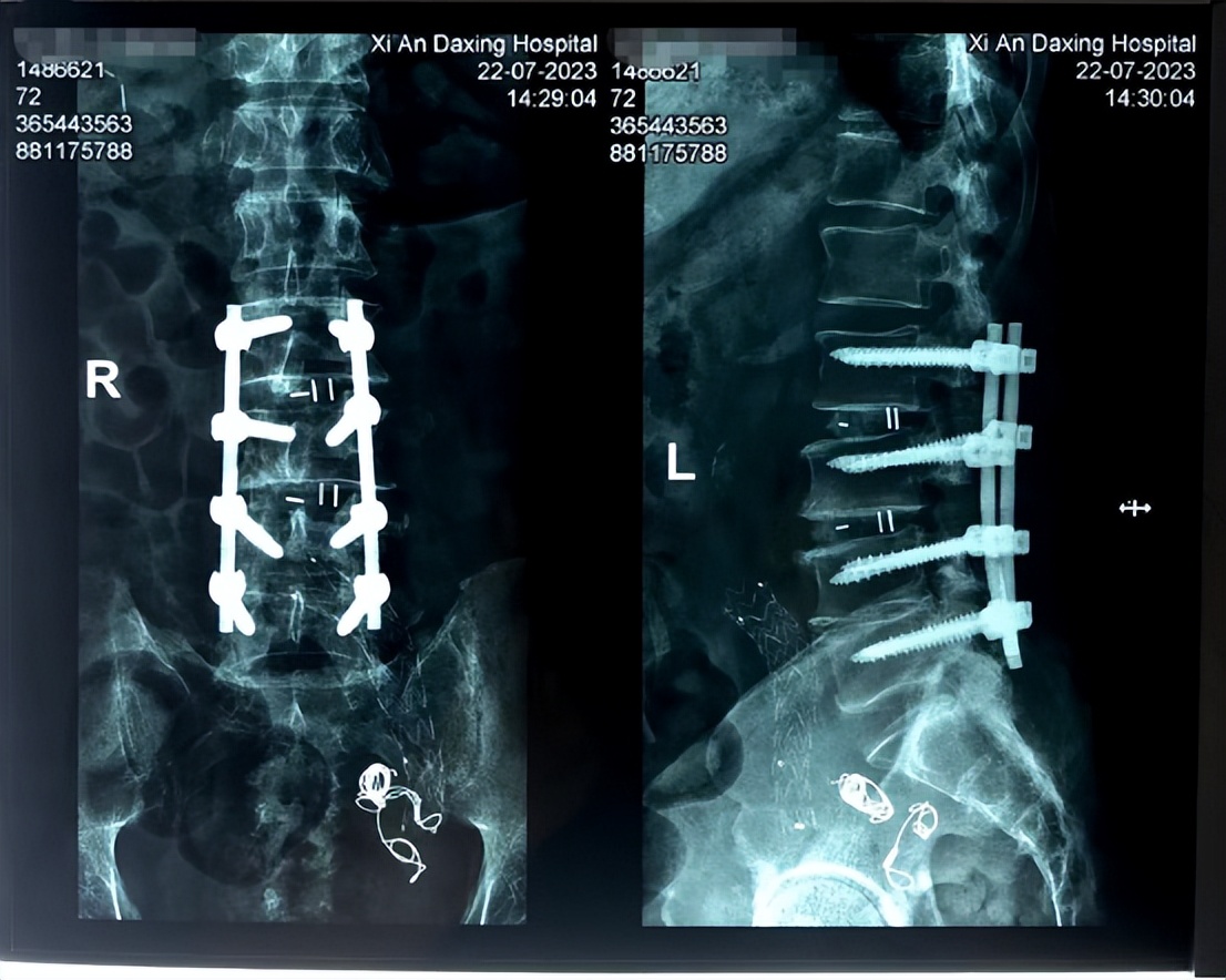 我的治疗腰突的曲折历程,我的门诊故事免费观看全集