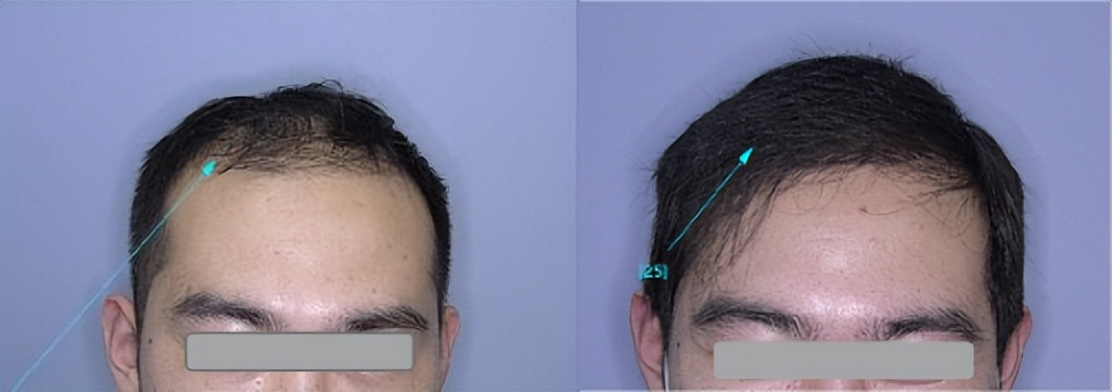脱发后毛发还能移植吗,毛发移植会脱发吗
