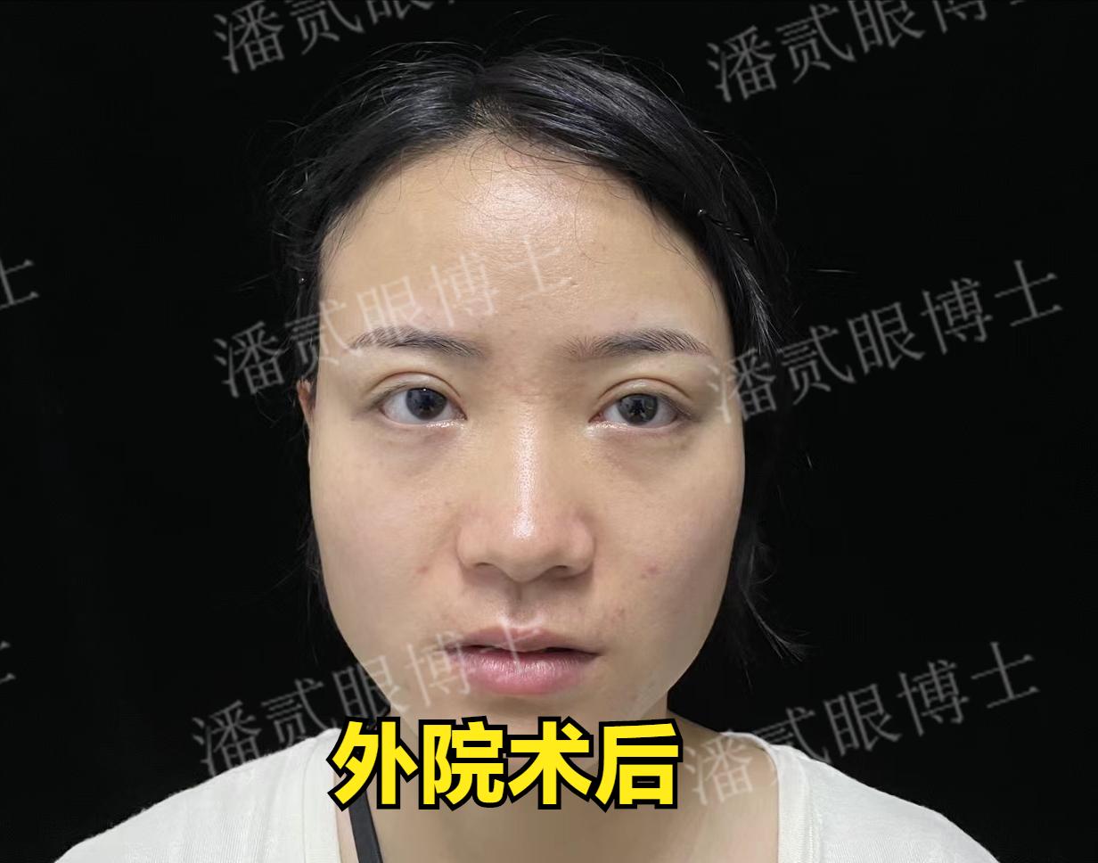 整容后眼睛不能闭合,整容失败眼睛无法闭合