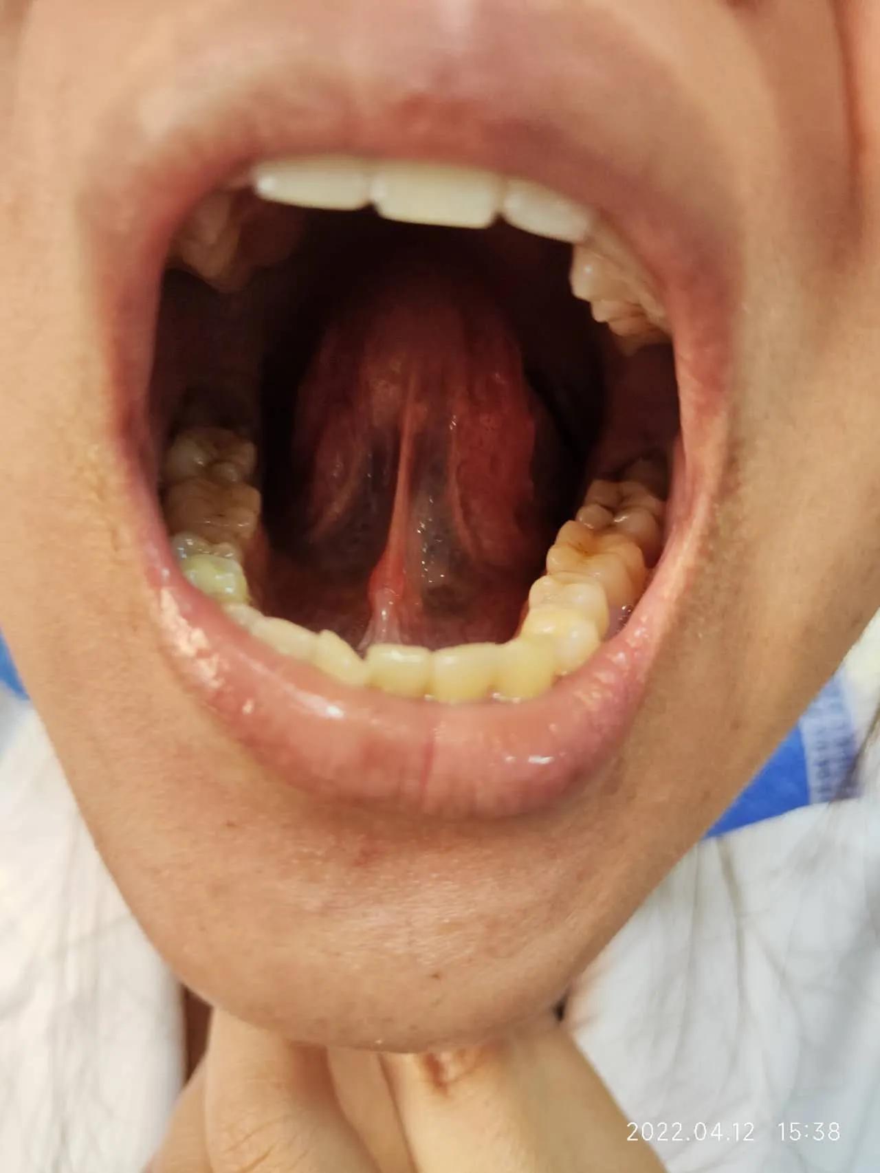 针药并用对发热的治疗效果如何,针药并用好处