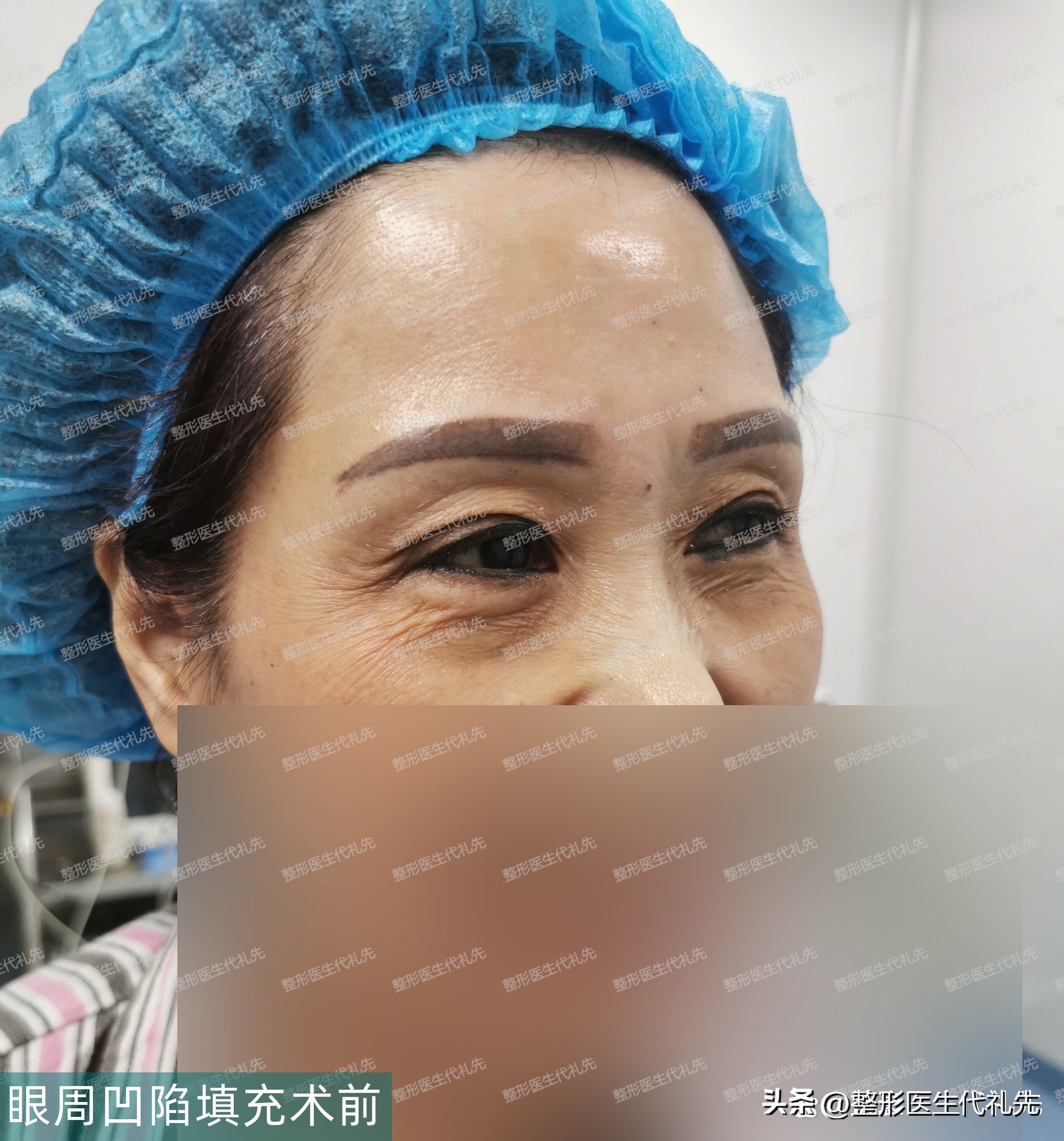 眼窝和法令纹凹陷很深怎么办,二十岁苹果肌饱满法令纹严重