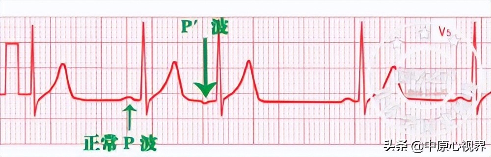 护考几种常见的心电图,常见的心电图图形分析