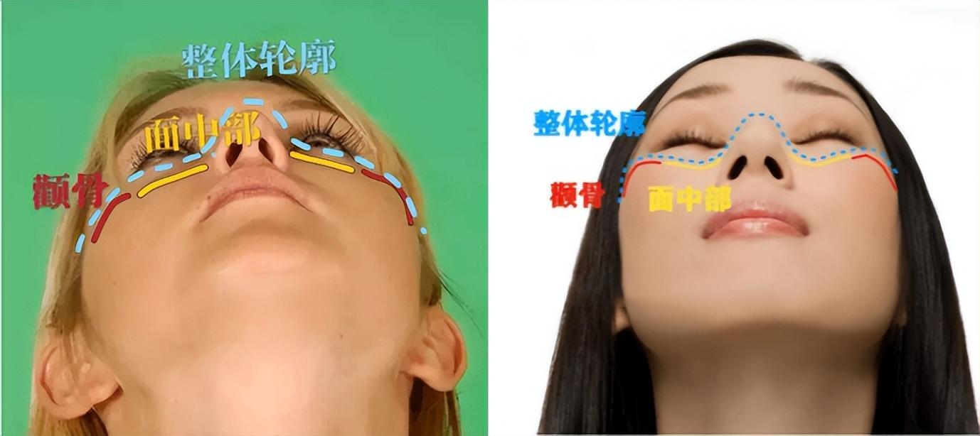 为什么大部分亚洲人都是扁头,正脸好看但侧脸丑到爆怎样办