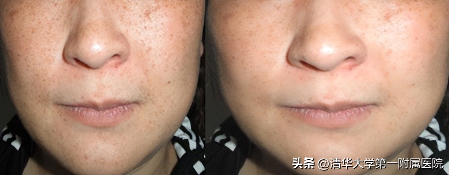 皮秒激光美白嫩肤祛斑紧肤,一起美起来