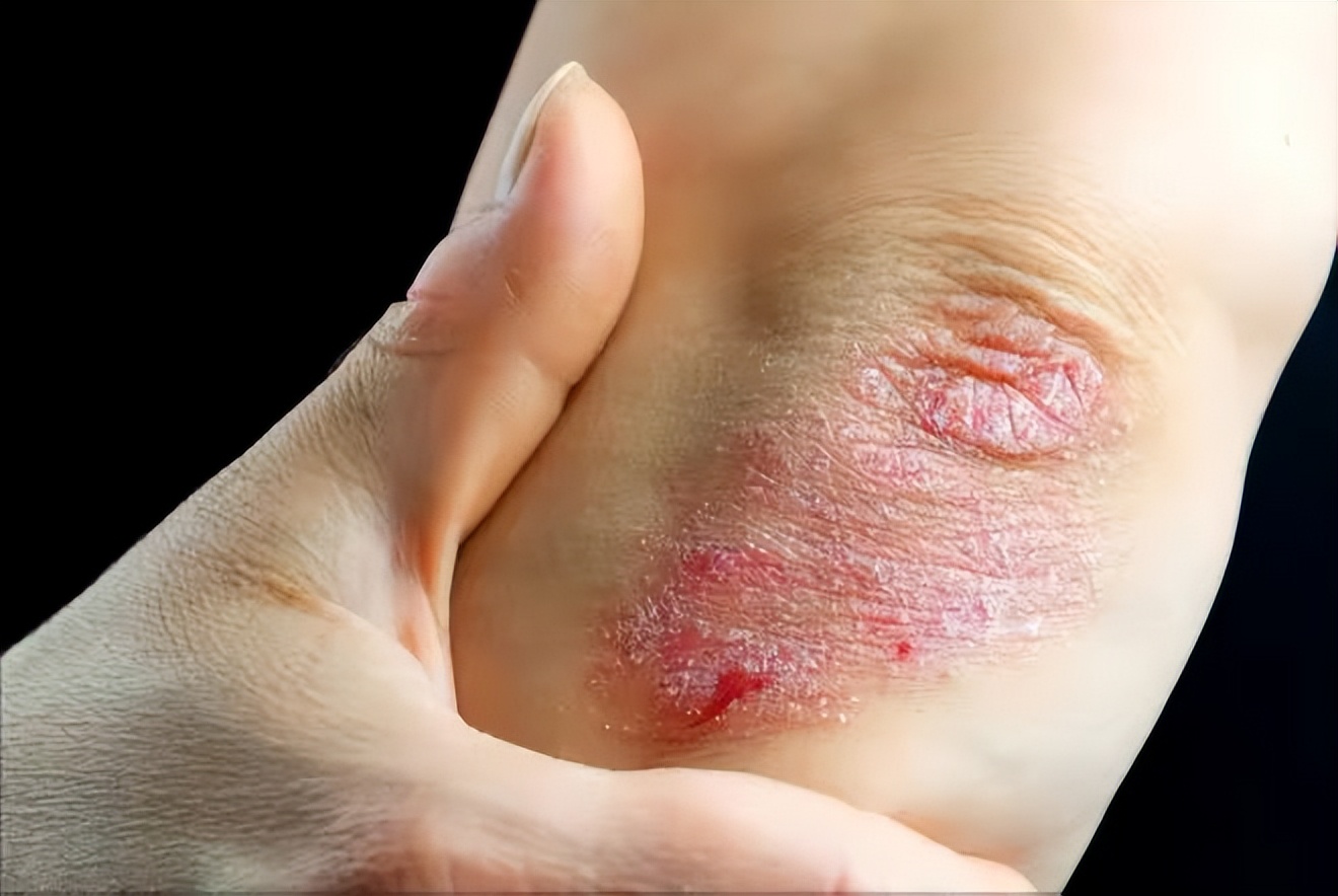 10种皮肤病特效药,皮肤病联合用药大全