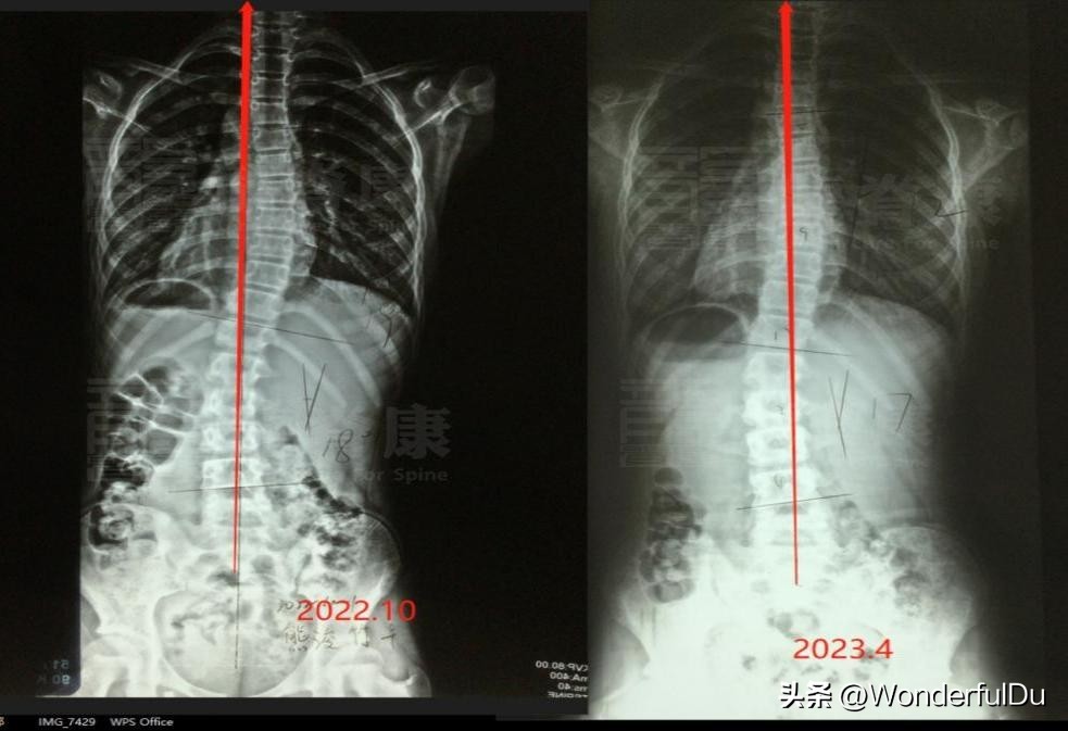 脊柱侧弯矫正改善,脊柱侧弯达到多少度需要矫正