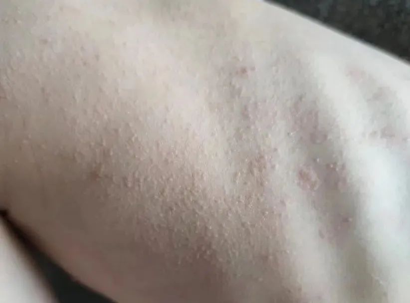 夏季常见皮肤问题医生教你,夏季皮肤瘙痒有什么方法