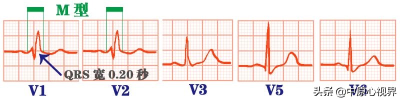 护考几种常见的心电图,常见的心电图图形分析