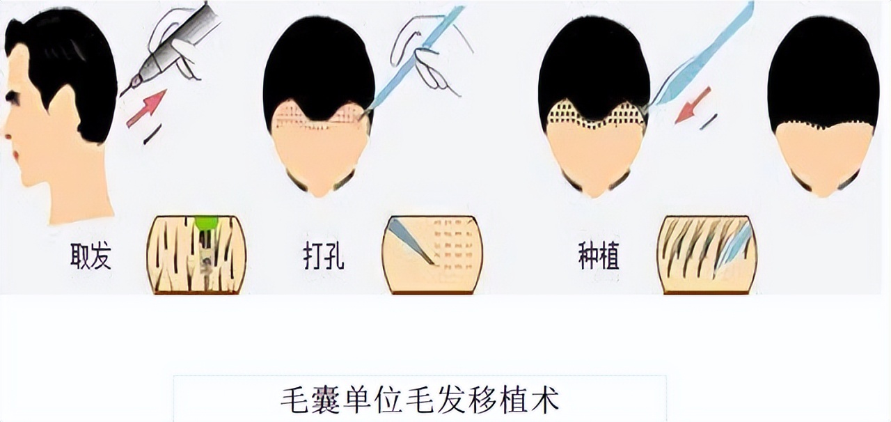 服用雄激素药物脱发怎么办,雄激素脱发用什么洗发水好