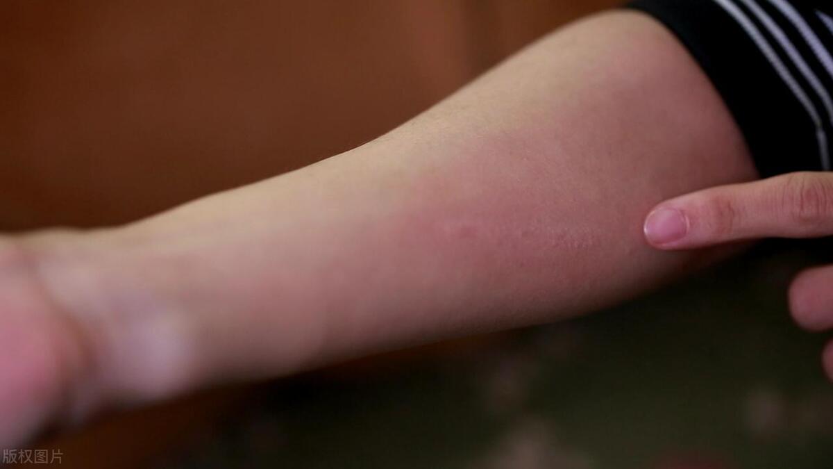 自闭症儿童有哪些食物不耐受?