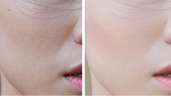 毛孔粗大怎么改善技巧图解,毛孔粗大如何改善简单小妙招