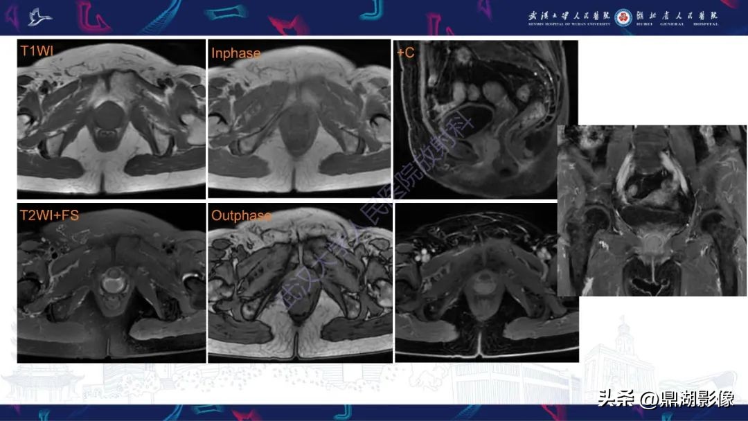 阴道肉瘤症状,阴道肉瘤的早期症状