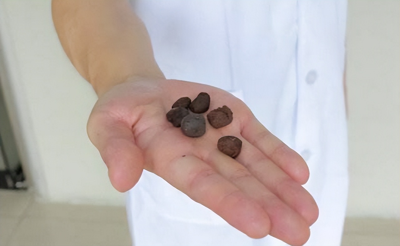 肾结石引起的高血压怎么办,肾结石和高血压有关系吗