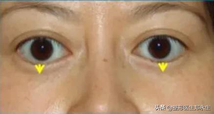 眼袋手术失败再次修复完交费吗,修复失败眼袋手术效果好吗