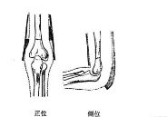 肱骨骨折取钢板怎样恢复,肱骨近端骨折切开复位内固定术