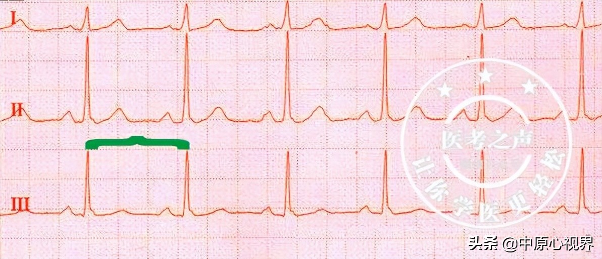 护考几种常见的心电图,常见的心电图图形分析