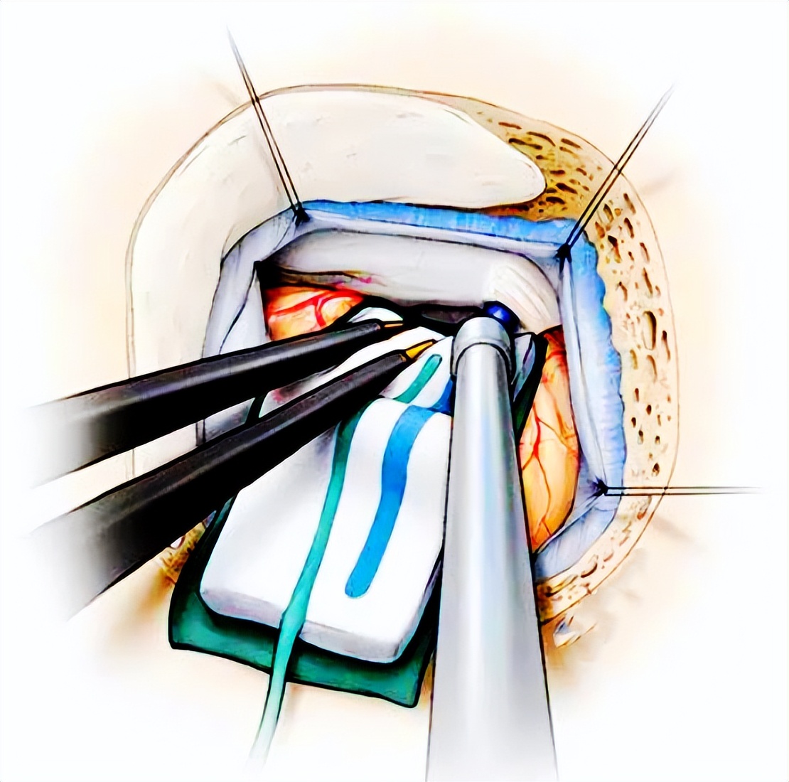 卡马西平治疗三叉神经痛多久停药,三叉神经痛吃什么药能彻底治愈