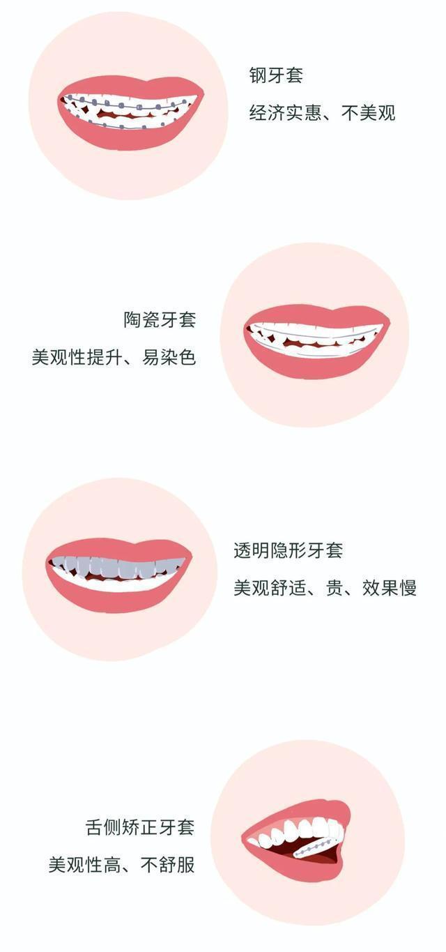 牙套矫正过程漫画,戴牙套是什么体验