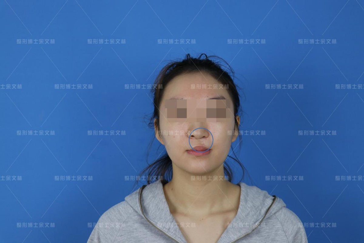 唇裂红唇修复,唇裂手术前后对比图