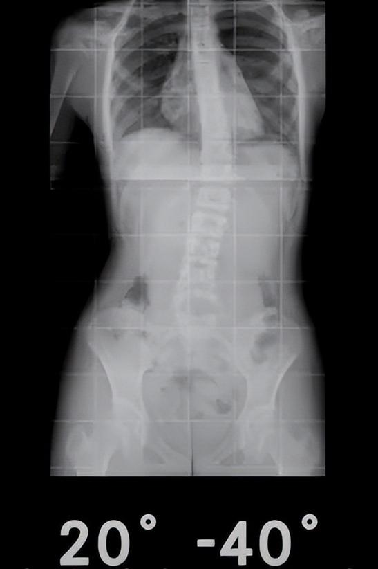 有哪些原因引起脊柱侧弯,有轻微脊柱侧弯怎么办