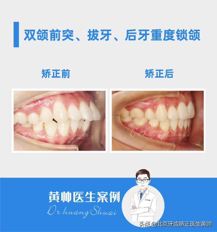 嘴凸的人怎么笑起来好看,嘴型比较凸的人怎么改善