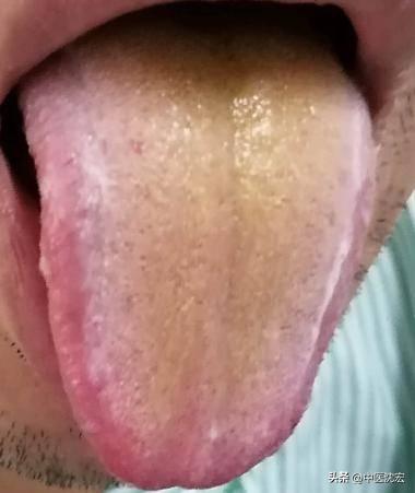 肝不好，人易倒，肝不好有这5种表现，教你5种中成药，养肝调肝