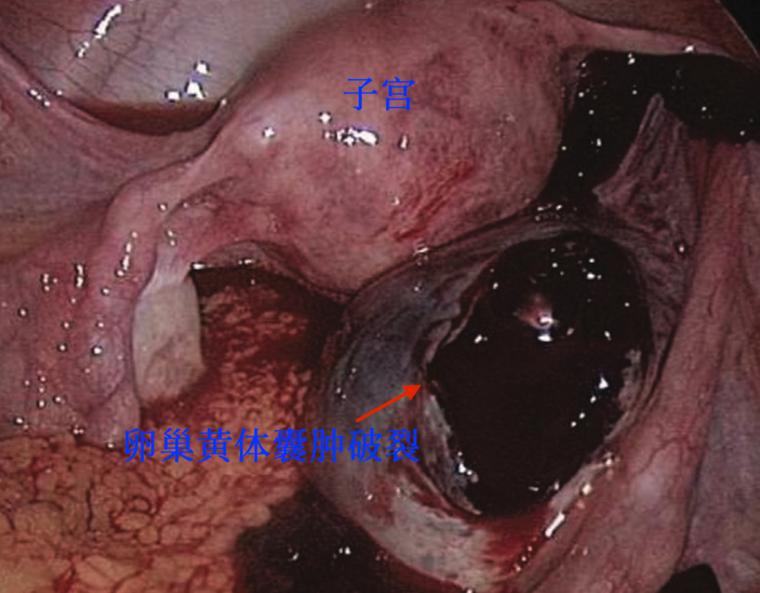超声显示子宫肌瘤卵巢囊肿,显微镜下的卵巢囊肿
