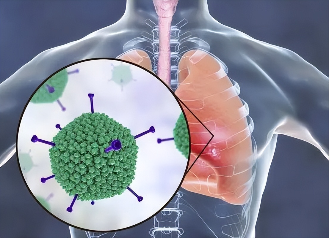 小儿肺炎怎么彻底治疗,小儿肺炎如何彻底治疗